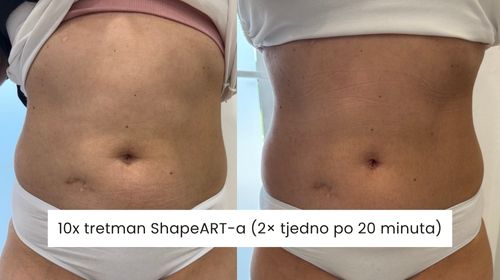 poslje 10 tretmana