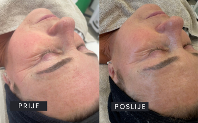 FaceART perfect - prije-poslije