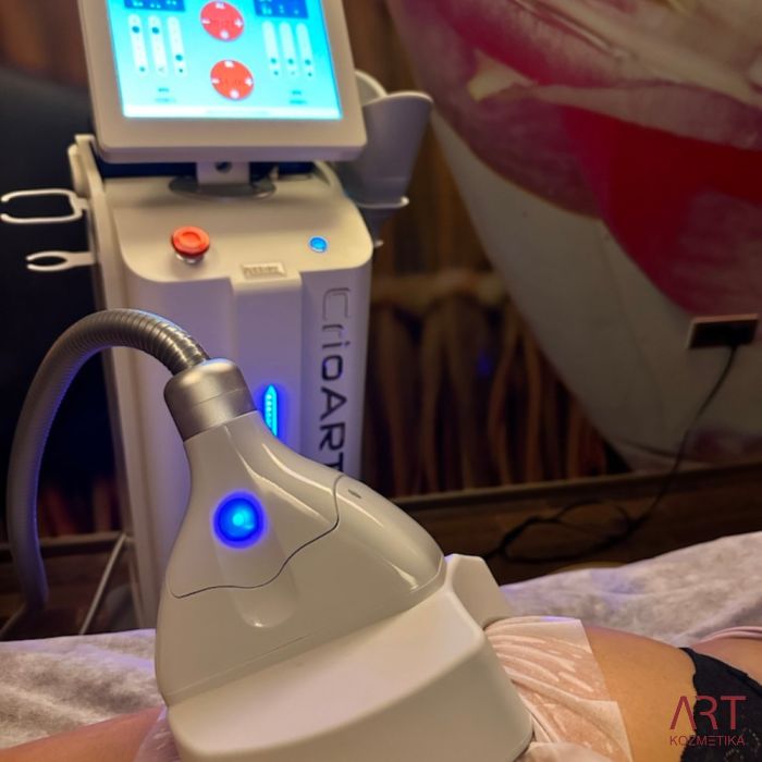 Kriolipoliza CrioART 360 - najam