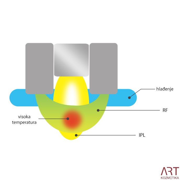 eLite Ana SHR IPL+RF