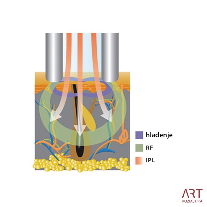 eLite Ana SHR IPL+RF