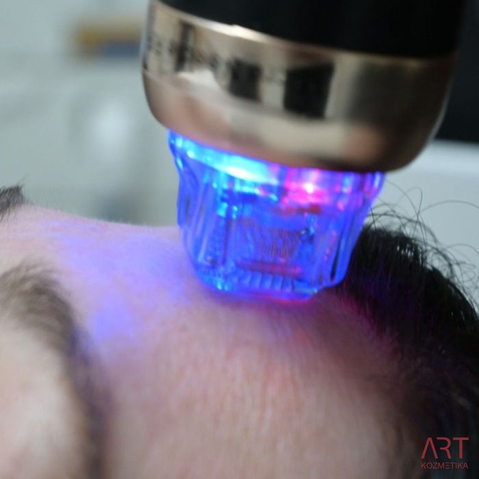 FaceART perfect -  napredna tehnologija za njegu lica - microneedling +RF + vacuum