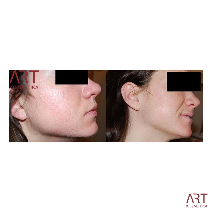 Beauty derma roler