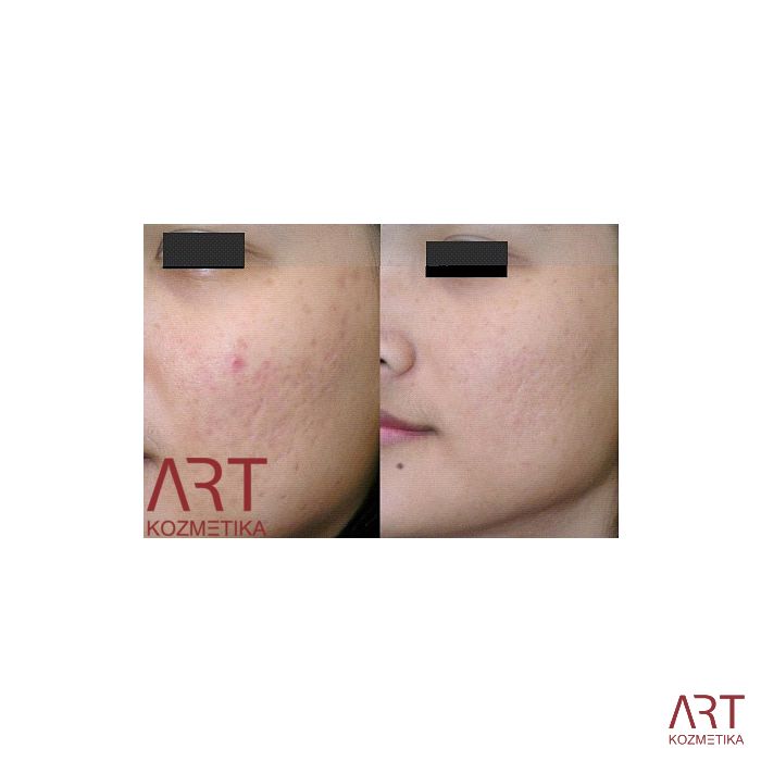 Beauty derma roler