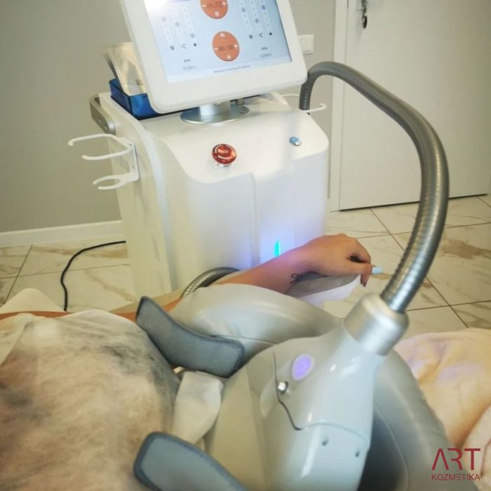 Kriolipoliza CrioART 360 - najam