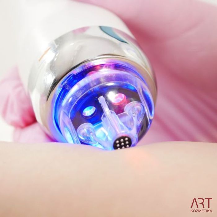 FaceART perfect -  napredna tehnologija za njegu lica - microneedling +RF + vacuum