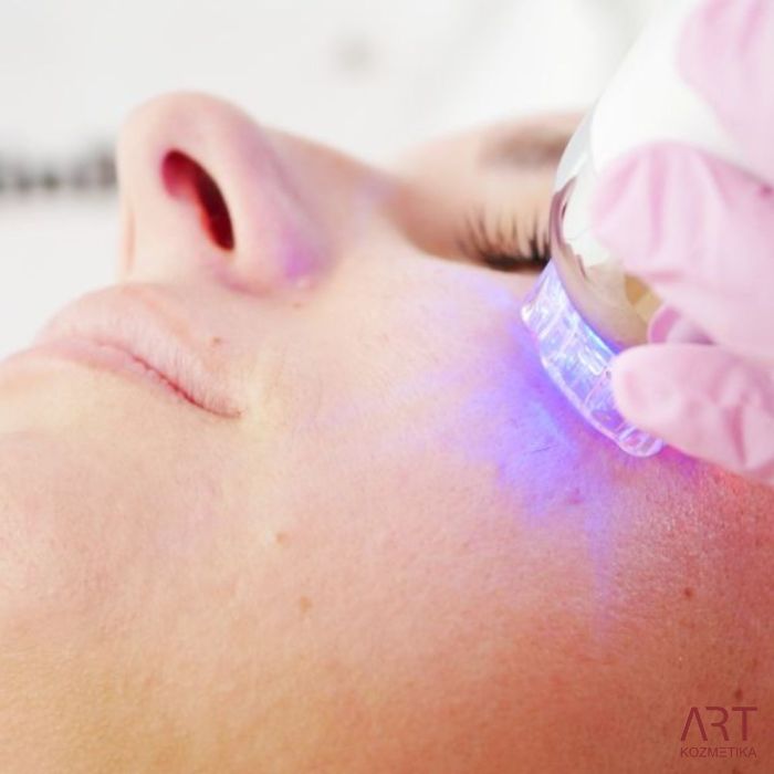 FaceART perfect -  napredna tehnologija za njegu lica - microneedling +RF + vacuum