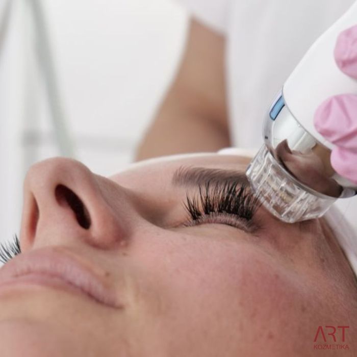 FaceART perfect -  napredna tehnologija za njegu lica - microneedling +RF + vacuum