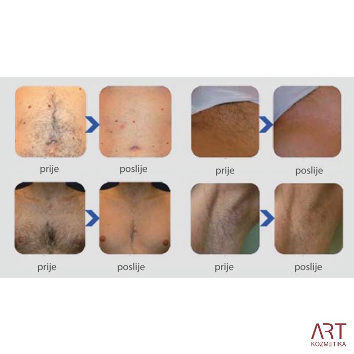 eLite Ana SHR IPL+RF