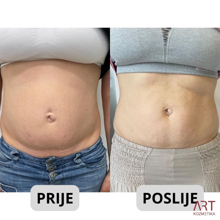 Kriolipoliza CrioART 360