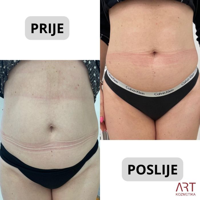 Kriolipoliza CrioART 360