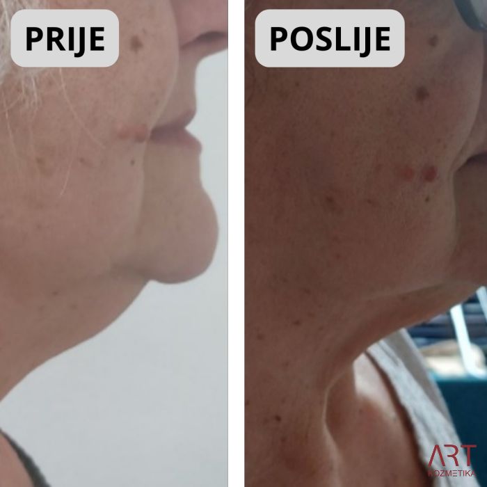 Kriolipoliza CrioART 360 - najam