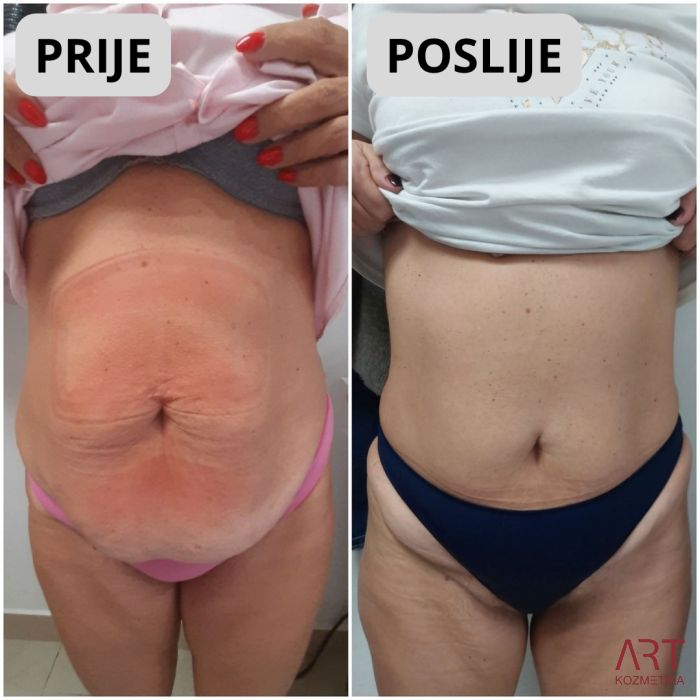 Kriolipoliza CrioART 360 - najam