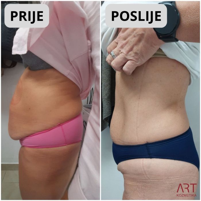 Kriolipoliza CrioART 360 - najam