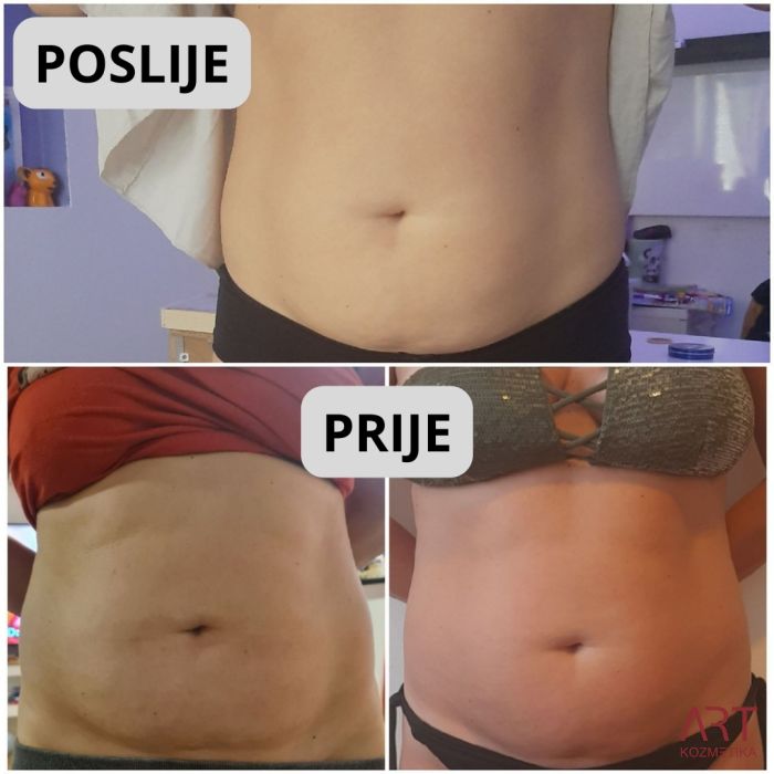 Kriolipoliza CrioART 360 - najam