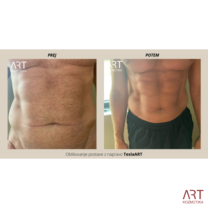 Elektromagnetni stimulacijski uređaj TeslaART - prijenosni mišićni stimulator za oblikovanje tijela