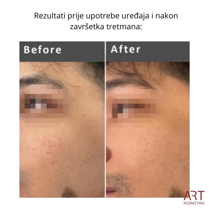 FaceART perfect -  napredna tehnologija za njegu lica - microneedling +RF + vacuum