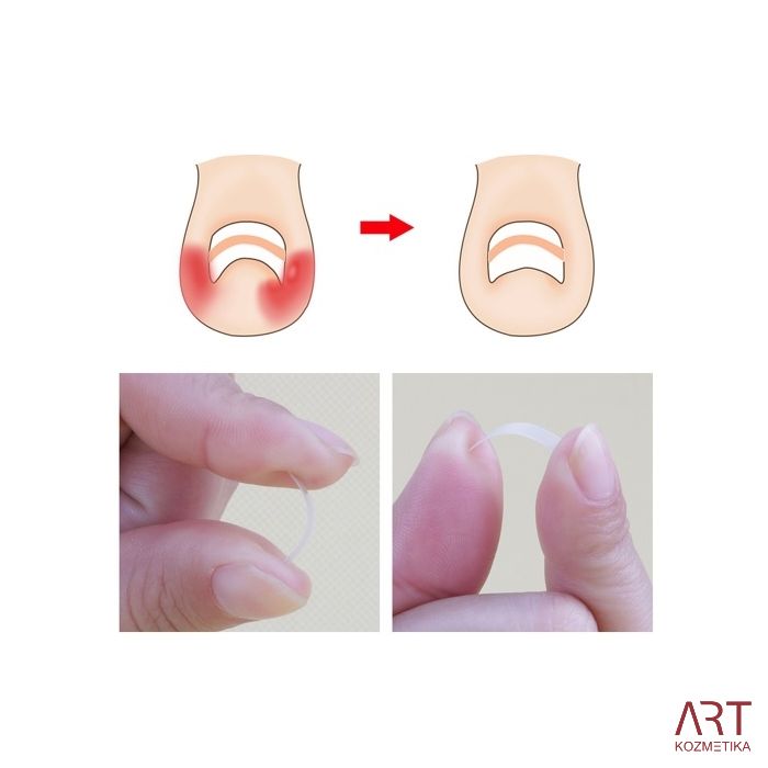 Sponke za vraščene nohte 10/1