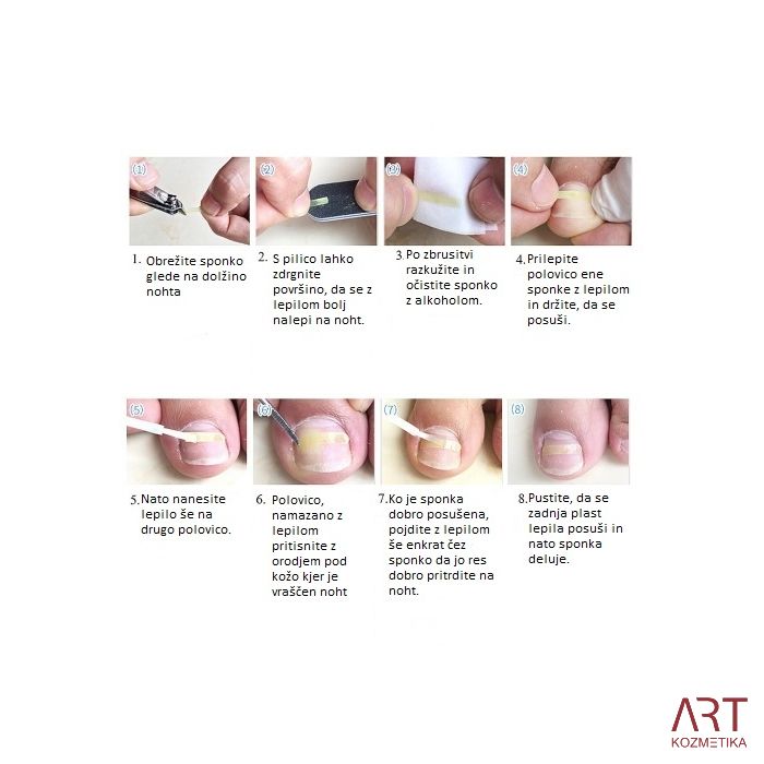 Sponke za vraščene nohte 10/1