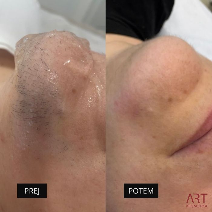 Diodni laser TrisCAM II