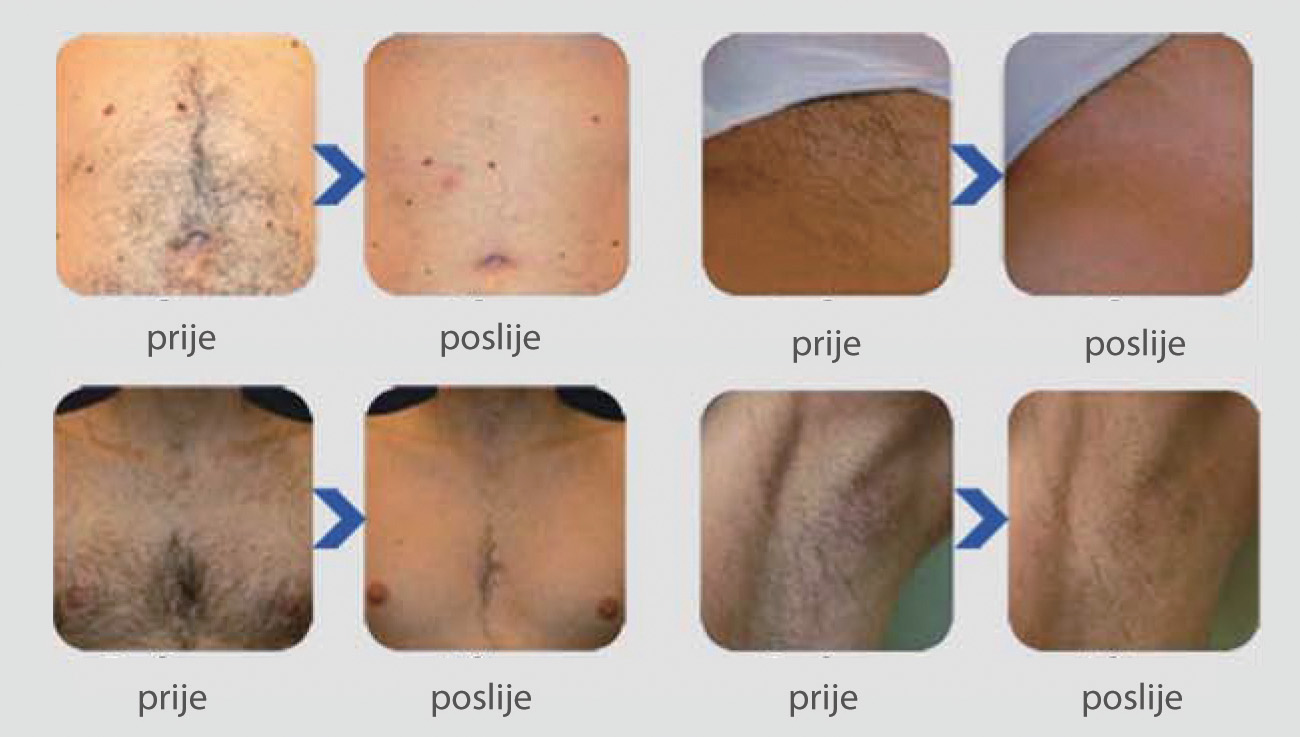 prije poslije tretmana eLite Ana prije poslije tretmana eLite Ana